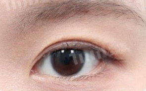 二重整形（二重切開＋ライン下げ） AFTER