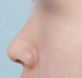 鼻整形（無プロテーゼ/鼻中隔延長/鷲鼻削り..） AFTER