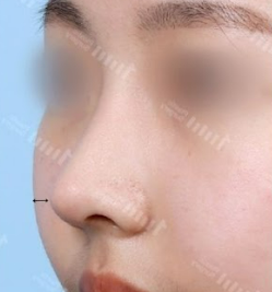 鼻整形（鷲鼻/鼻筋/鼻先/短い鼻矯正/骨切り幅寄せ） AFTER