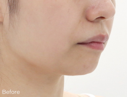 Ai リフティング BEFORE