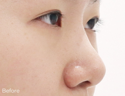 Ai ハイコ（鼻フィラー1cc＋ミント糸4本） BEFORE