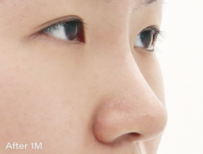 Ai ハイコ（鼻フィラー1cc＋ミント糸4本） AFTER