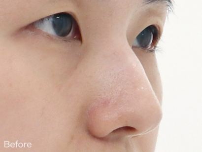 Ai ハイコ（鼻フィラー1cc＋ミント糸4本） BEFORE