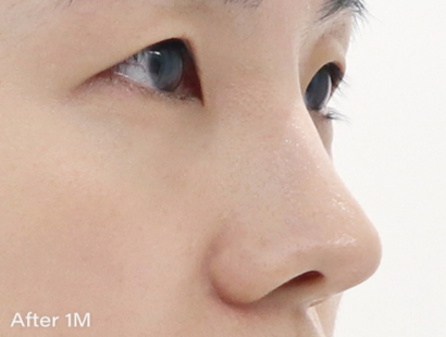 Ai ハイコ（鼻フィラー1cc＋ミント糸4本） AFTER
