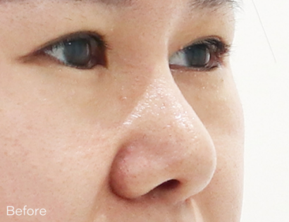 Ai ハイコ（鼻フィラー1cc＋ミント糸4本） BEFORE