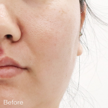 Ai スキンブースター BEFORE