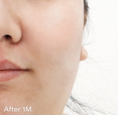 Ai スキンブースター AFTER