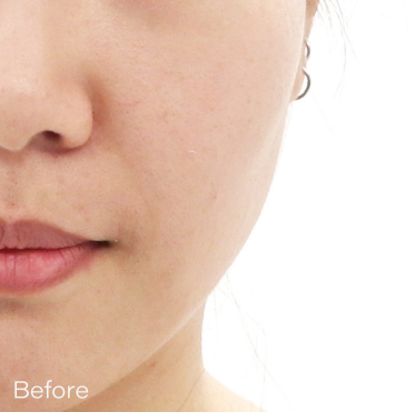 Ai スキンブースター BEFORE