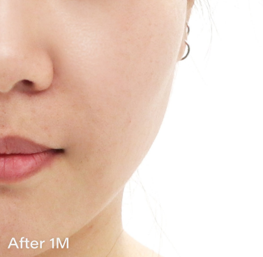 Ai スキンブースター AFTER