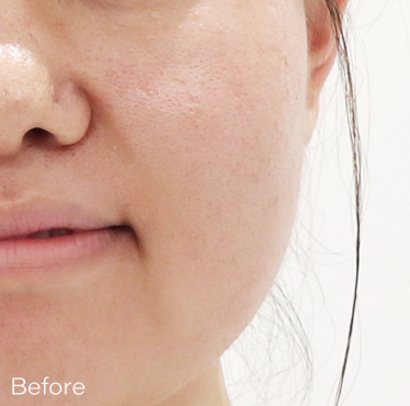 Ai スキンブースター BEFORE