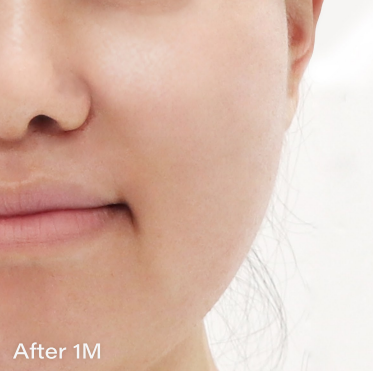 Ai スキンブースター AFTER