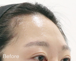 Ai フィラー（ヒアルロン酸） BEFORE