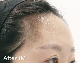 Ai フィラー（ヒアルロン酸） AFTER