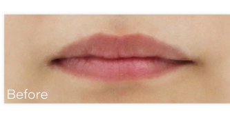 Ai フィラー（ヒアルロン酸） BEFORE