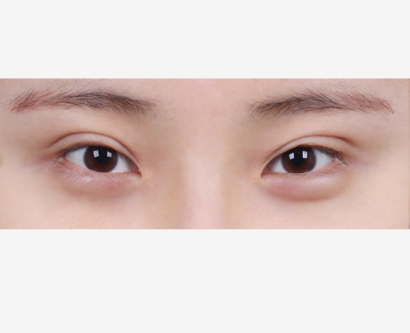 目つき矯正 BEFORE