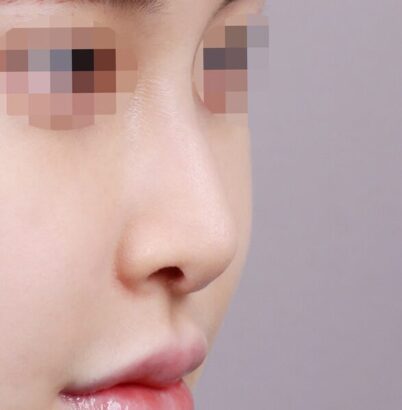 鼻整形 BEFORE