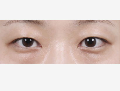 目の下脂肪再配置 BEFORE