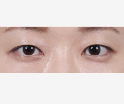 目の下脂肪再配置 AFTER
