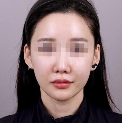 エラ削り+顎削り AFTER