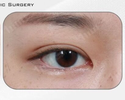 二重整形（自然癒着） AFTER