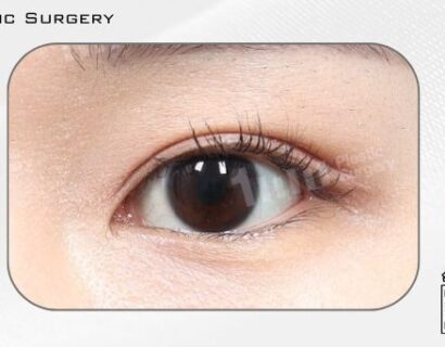 二重整形（自然癒着） AFTER