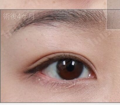 二重整形（自然癒着＋目上切開） AFTER