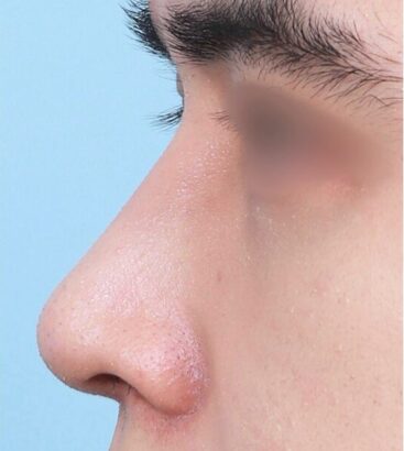 鼻整形（鼻中隔延長/小鼻縮小） AFTER