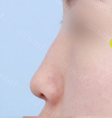 鼻整形（無プロテーゼ/鼻中隔延長/鷲鼻削り..） BEFORE