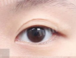 二重整形（二重切開＋ライン下げ） BEFORE