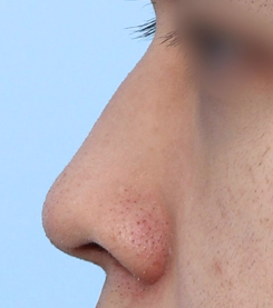 鼻整形（鼻中隔延長/小鼻縮小） BEFORE