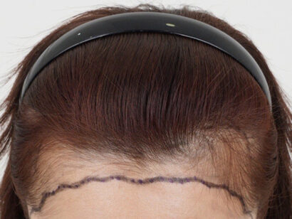 ヘアライン2500毛 BEFORE