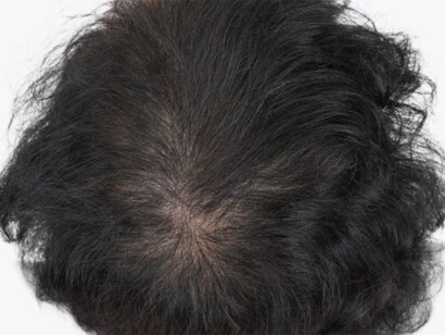 頭頂部4500毛 AFTER