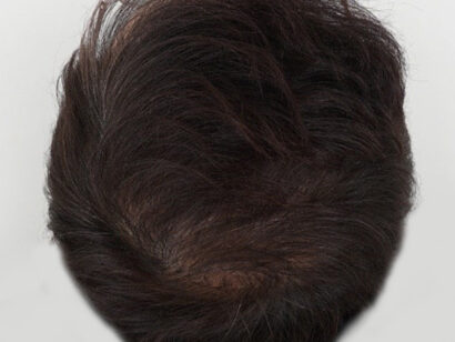 前頭部5500毛 AFTER