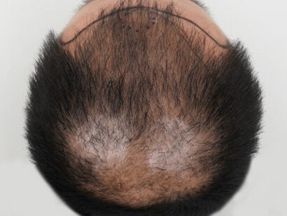 前頭部5500毛 BEFORE