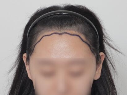 女性の生え際 BEFORE