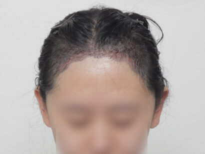 女性の生え際 AFTER