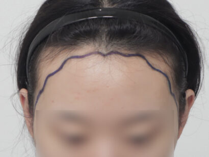 女性の生え際 BEFORE