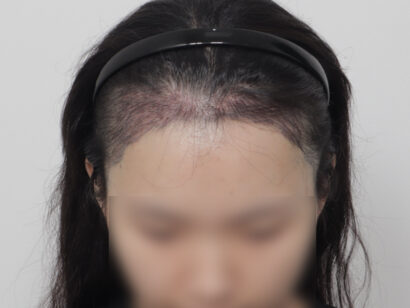 女性の生え際 AFTER