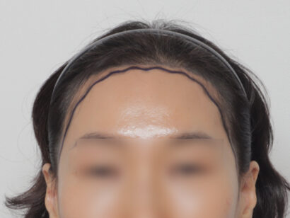 女性の生え際 BEFORE