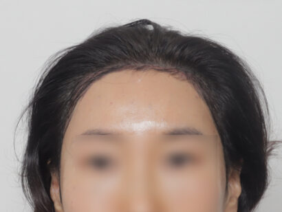 女性の生え際 AFTER