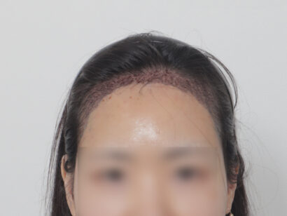 女性の生え際 AFTER