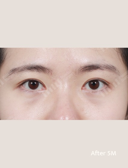 1mm美容整形外科の自然な鼻整形施術イメージafter