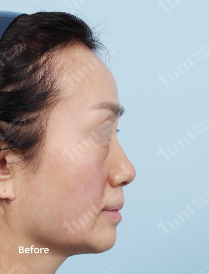 施術前のフェイスライン