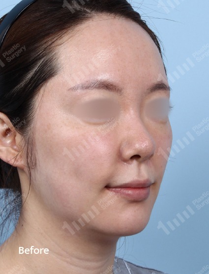 施術前のフェイスライン