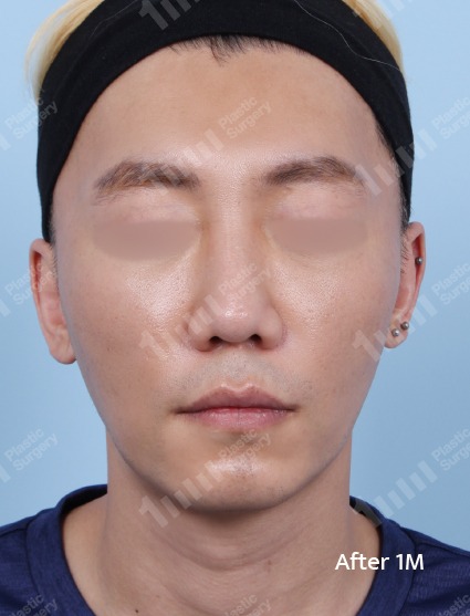 施術後のフェイスライン