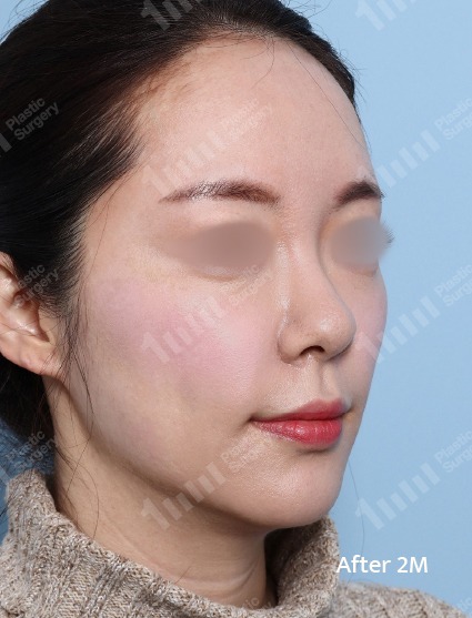 施術後のフェイスライン