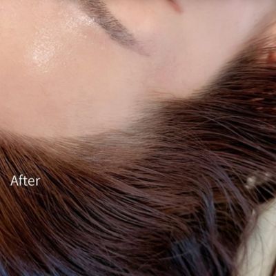 Natural Hair Line AFTER