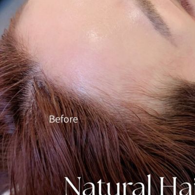 Natural Hair Line BEFORE
