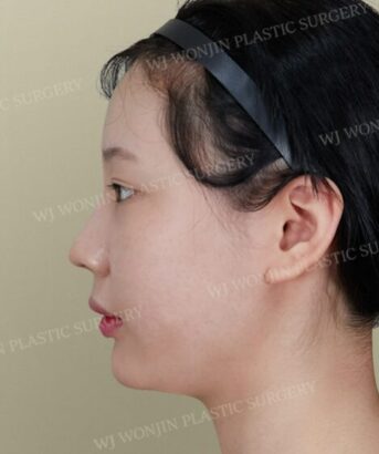 鼻の整形 BEFORE