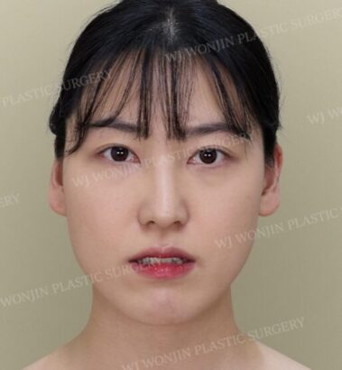 輪郭整形 BEFORE